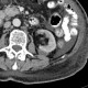 Hematoma after renal biopsy: CT - Computed tomography